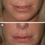 A New Classification Of Lip Zones To Customize Injectable
