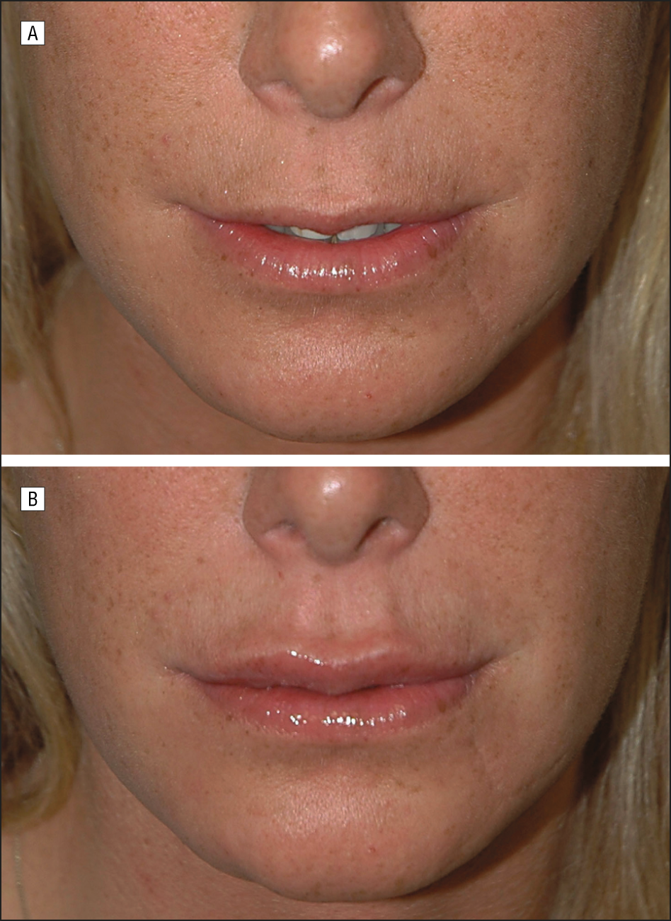 A New Classification Of Lip Zones To Customize Injectable 