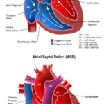 Atrial Septal Defect Children S Health Orange County