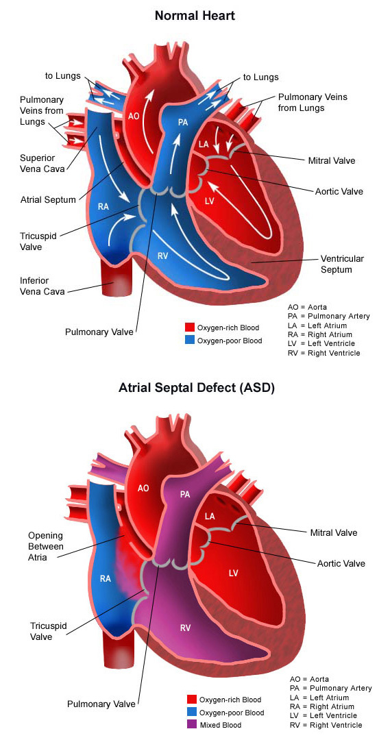 Atrial Septal Defect Children s Health Orange County