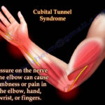 Cubital Tunnel Syndrome Ulnar Nerve Entrapment