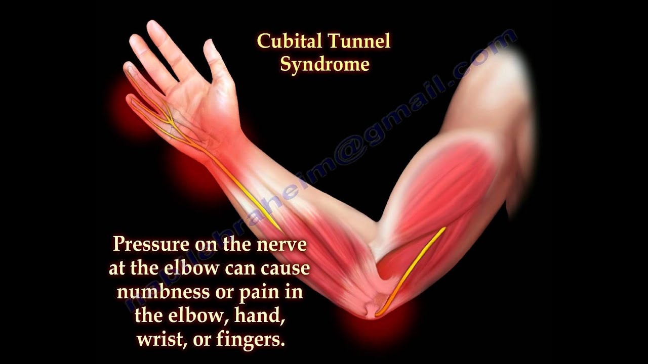 Cubital Tunnel Syndrome Ulnar Nerve Entrapment 