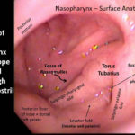 Flexible Fiberoptic Laryngoscopy Written Instruction