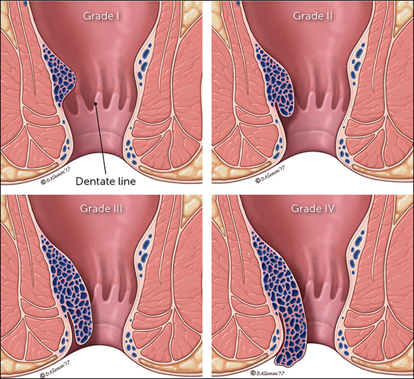 Hemorrhoids Diagnosis And Treatment Options American 