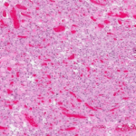 Histological Presentation Showing Angiomatous Meningioma