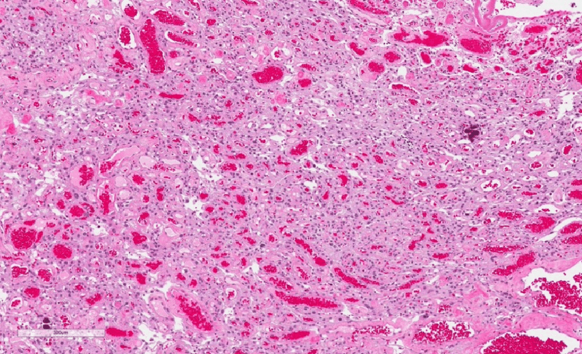 Histological Presentation Showing Angiomatous Meningioma 