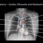 How To Interpret A Chest X Ray Lesson 2 A Systematic