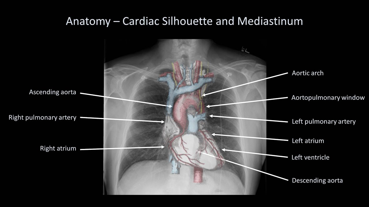 How To Interpret A Chest X Ray Lesson 2 A Systematic 