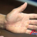Numbness In Fingers Hand Huntington Beach Chiropractor