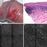 Differentiation Between Balanitis And Carcinoma In Situ