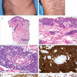 Disseminated Mantle Cell Lymphoma Presenting As A