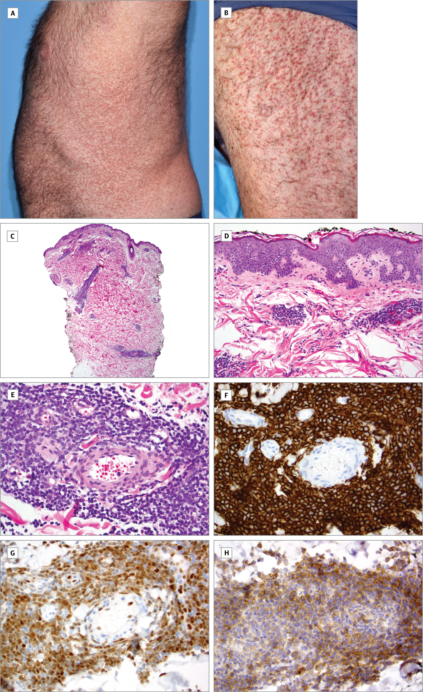 Disseminated Mantle Cell Lymphoma Presenting As A 