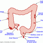 Gastrointestinal GI Bleeding Suburban Gastroenterology