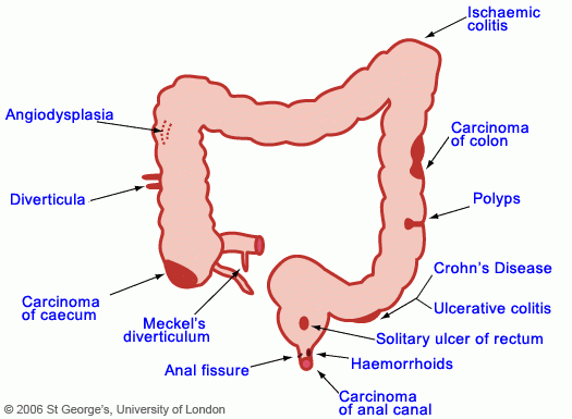 Gastrointestinal GI Bleeding Suburban Gastroenterology 