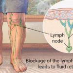 Lymphedema Ulcer Dr Novikov Wellness And Skin Care