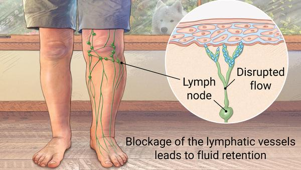 Lymphedema Ulcer Dr Novikov Wellness And Skin Care