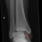 Maisonneuve Fracture Radiology At St Vincent S