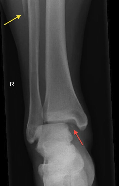 Maisonneuve Fracture Radiology At St Vincent s 