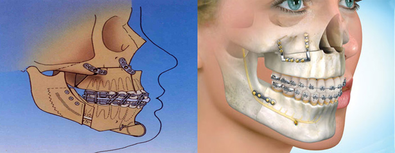 Orthognathic Surgery MIDAC