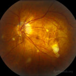 Pathologic Myopia With Bilateral Posterior Staphylomas