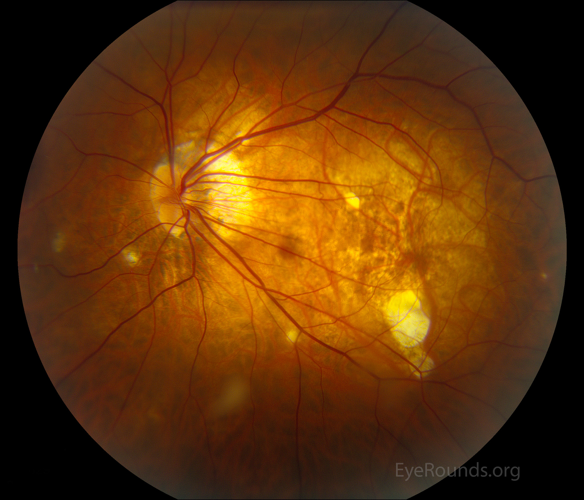 Pathologic Myopia With Bilateral Posterior Staphylomas