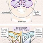 Sinusitis Treatment And Surgery NYC
