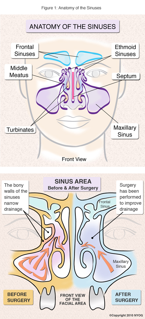 Sinusitis Treatment And Surgery NYC
