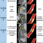 The Radiology Assistant Coronary Artery Disease