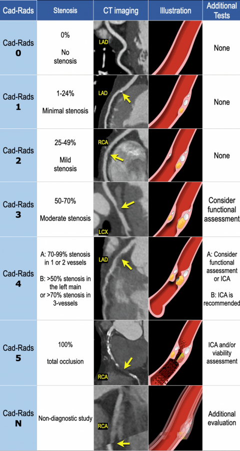 The Radiology Assistant Coronary Artery Disease 